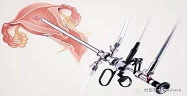 【婦科】帶你了解什么是宮腔鏡手術(shù)