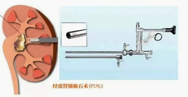 不懂經(jīng)皮腎鏡是什么？軒科告訴你！